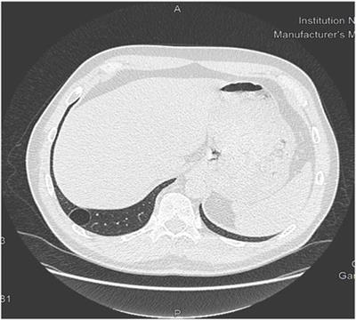 Chest CT scan for the screening of air anomalies at risk of pulmonary barotrauma for the initial medical assessment of fitness to dive in a military population